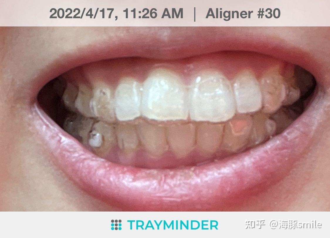 用镊子拔牙的过程，女性病人在牙科诊所手术期间的特写肖像照片摄影图片_ID:310878521-Veer图库