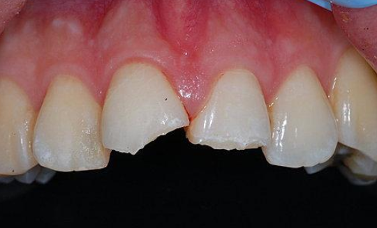 门牙断了一半拔牙还是补牙