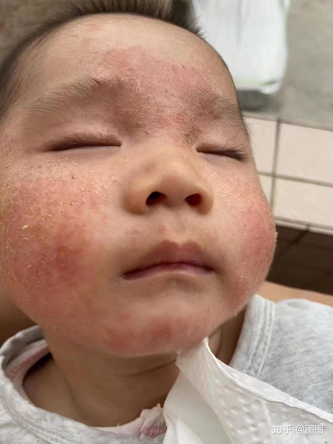 婴儿干燥性湿疹图片（冬天孩子反复湿疹）-幼儿百科-魔术铺