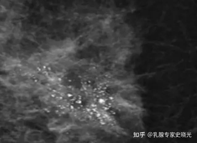乳腺结节钙化灶,这 3 个危险信号,千万别忽视 - 知乎