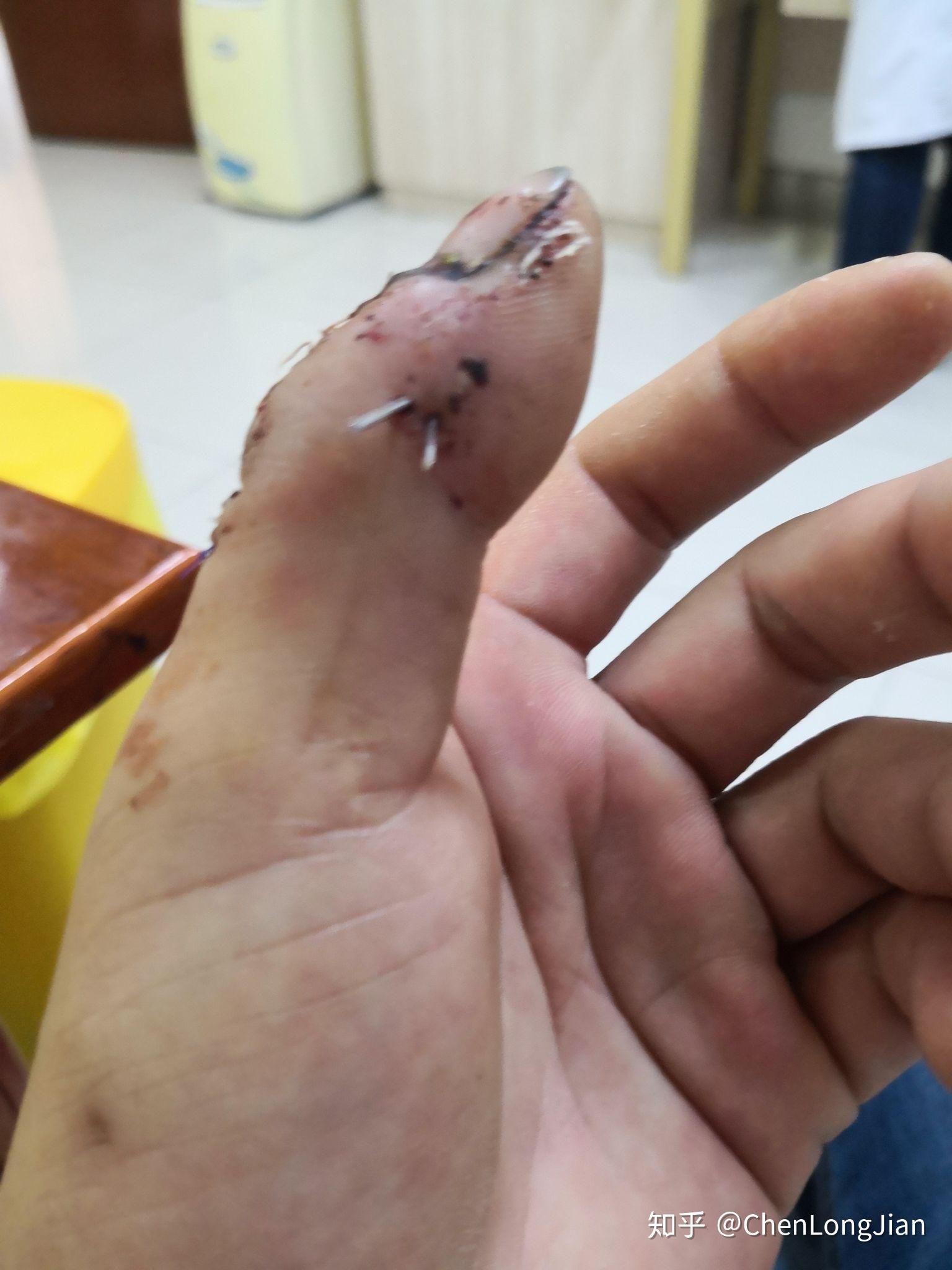 手指头骨折是种怎样的体验? - 知乎