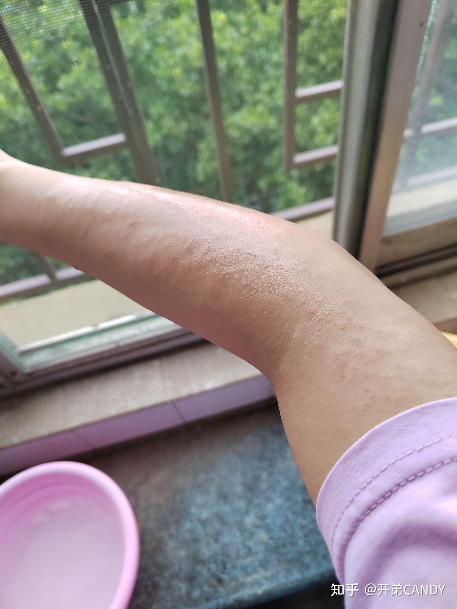 想问一下大家用完脱毛膏有没有红肿过敏或者其他副作用