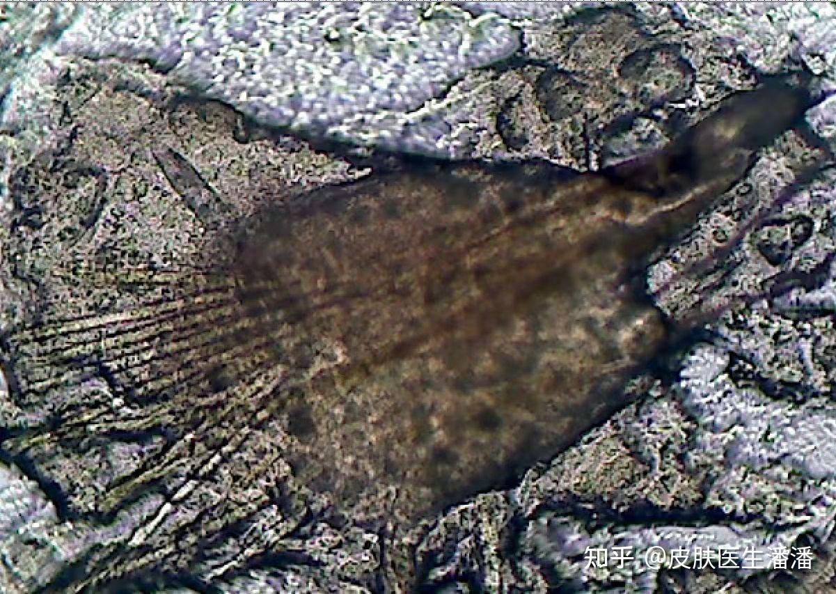 诊间笔记:严重的小棘状毛壅病 - 知乎