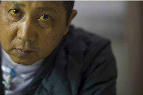 早期胰腺癌常被当成胃病出现这5个症状警惕胰腺癌