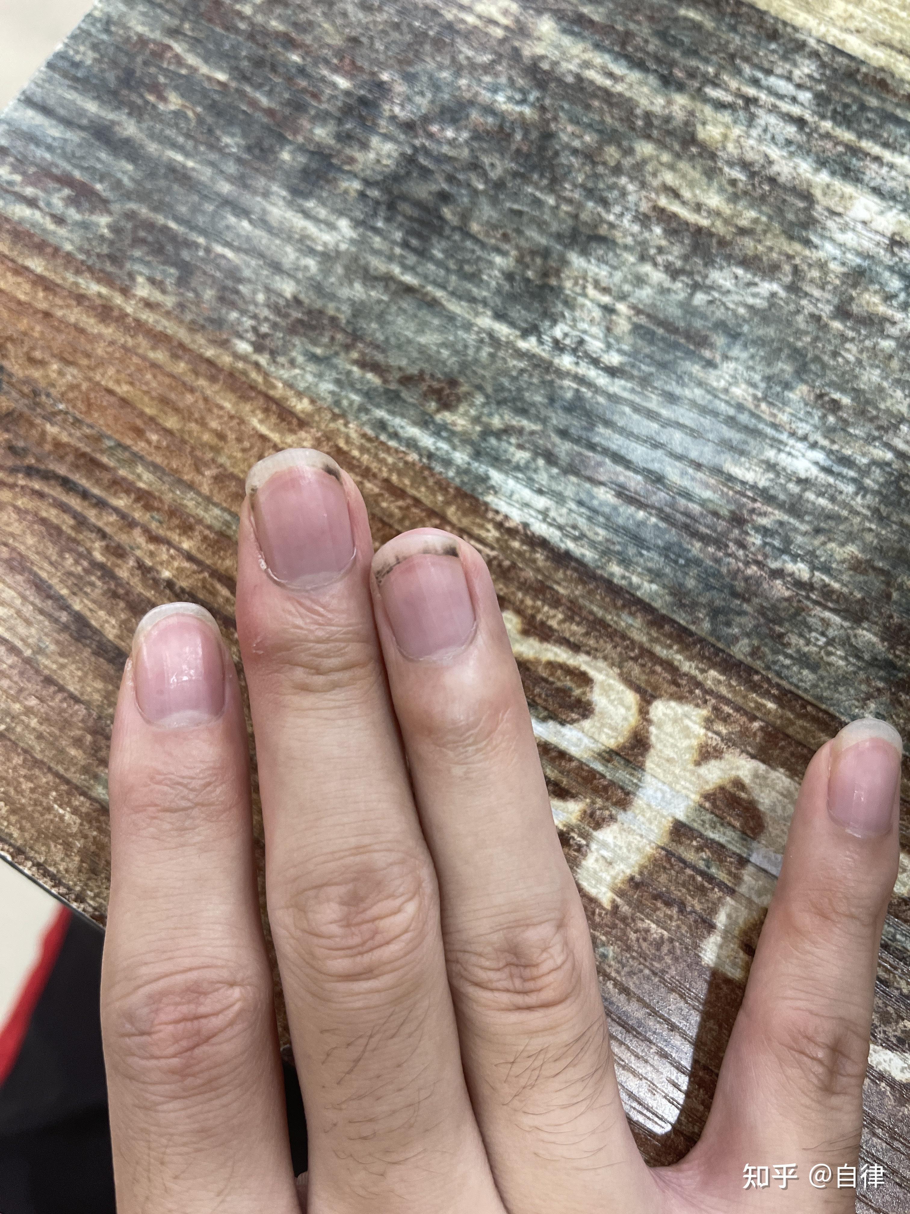 指甲上有黑褐色短竖纹（见图），是什么原因？改如何改善？谢谢！_百度知道