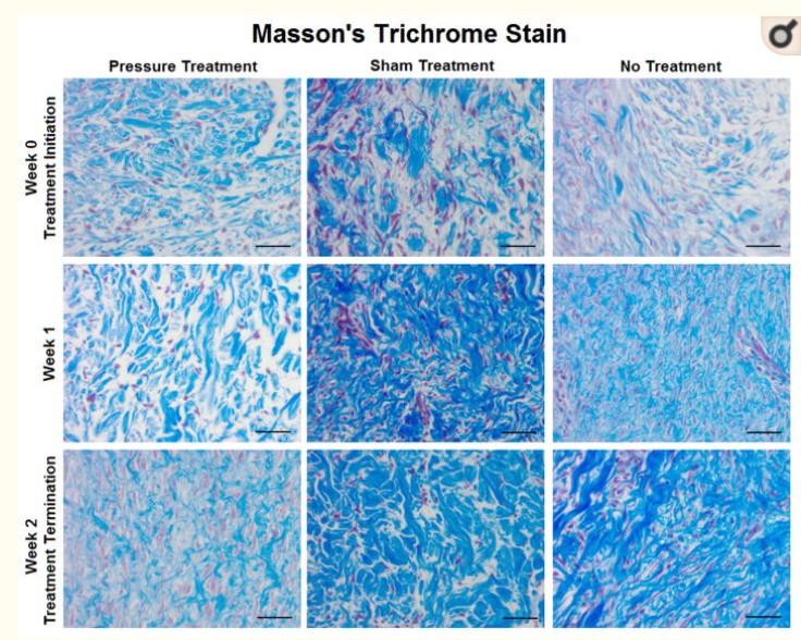 烧伤疤痕增生压迫疗法影响增生性瘢痕中的胶原类型平衡