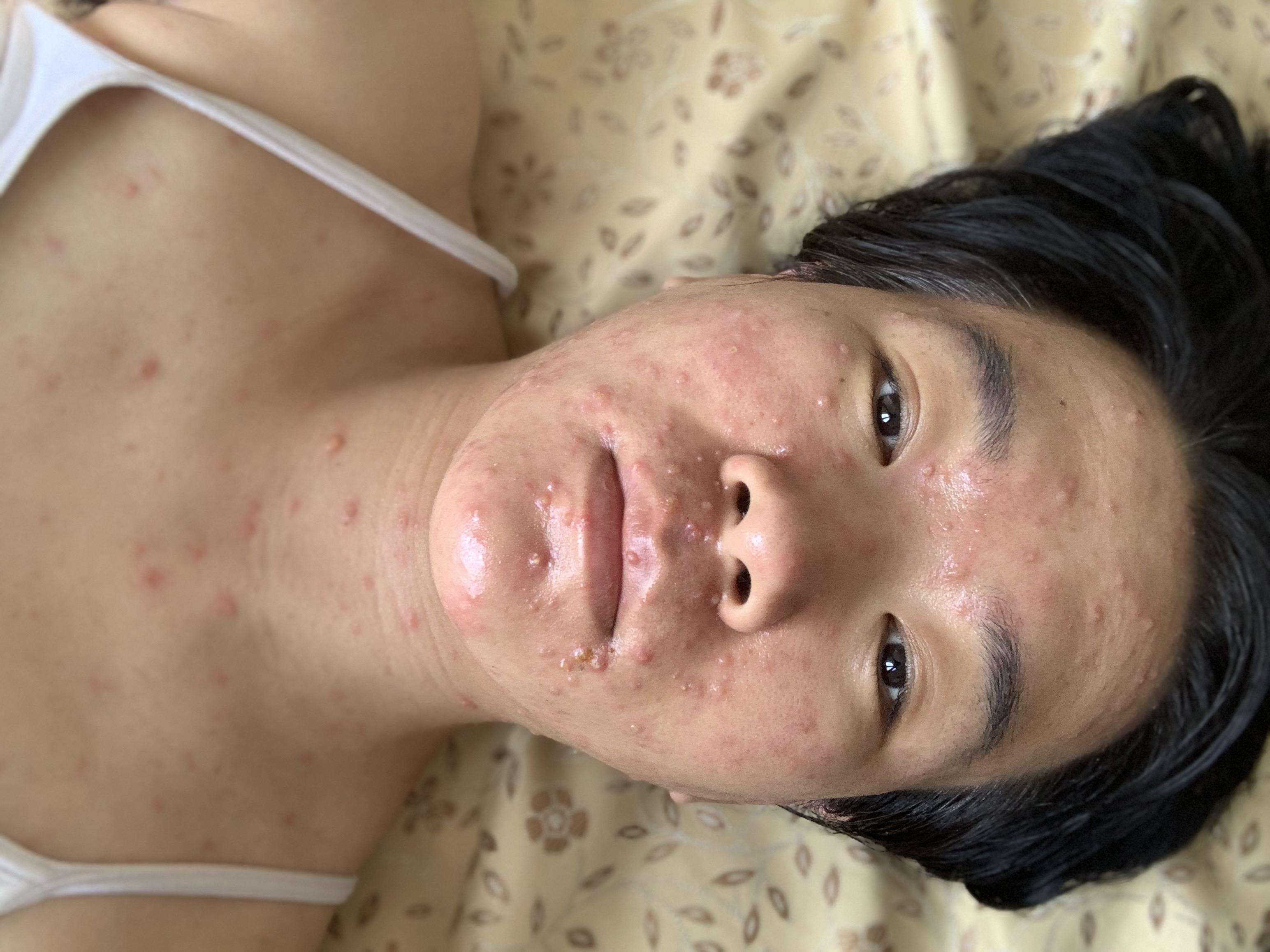 成人长水痘是什么样的经历