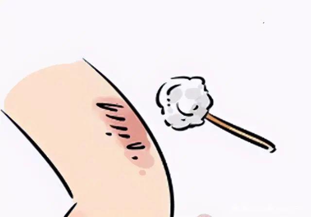 预防疤痕产生的黄金法则