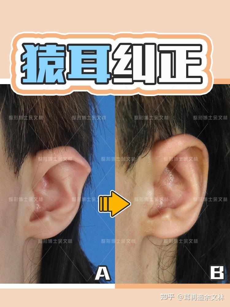 【案例分析】耳朵形似猿耳朵的男子,因不满耳朵外形来做手术矫正