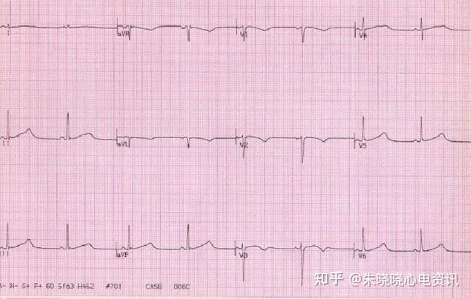 猝死心電圖如期而至!3種易漏診