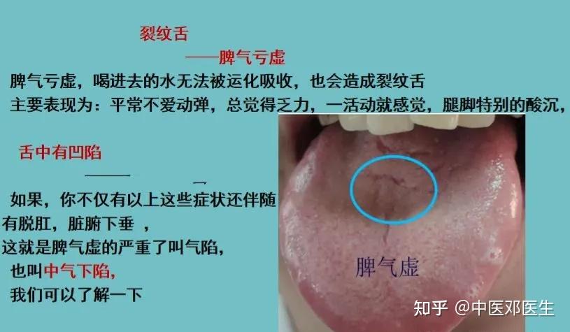 舌有裂纹,除了是阴虚,还要注意是气虚 - 知乎
