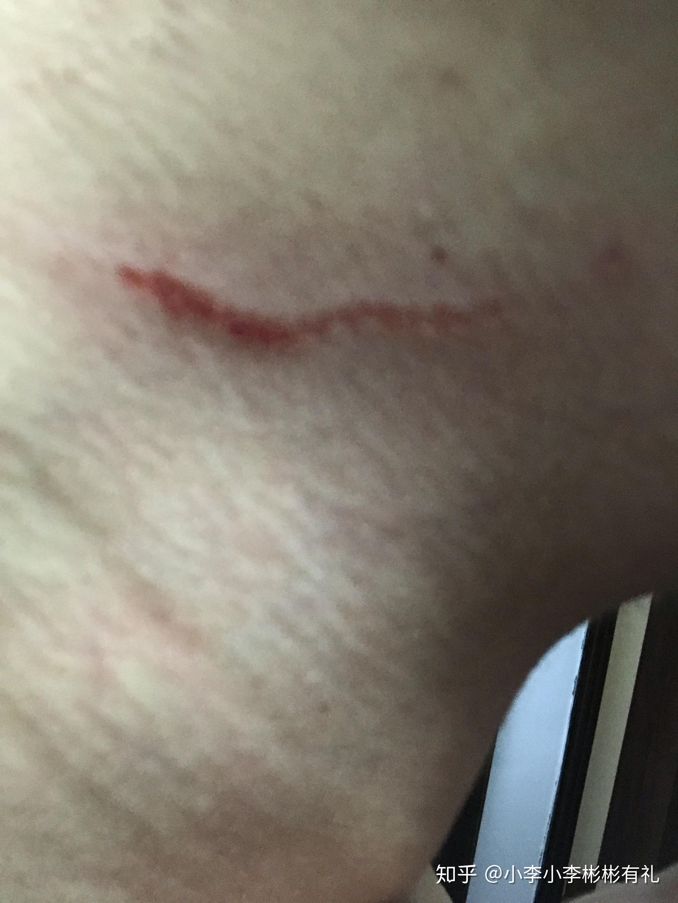 睡觉醒来,发现脖子前面被自己抓破了,是为什么啊? - 知乎