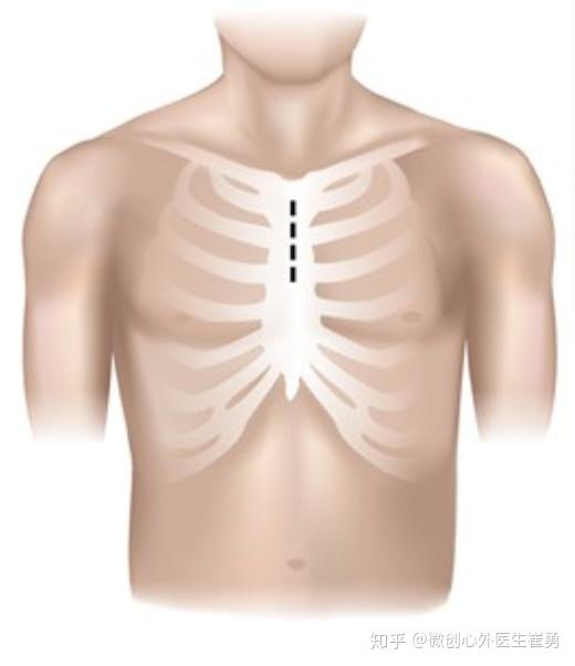 优点:胸廓完整性得到更好保留,对于患者的呼吸功能影响较小.