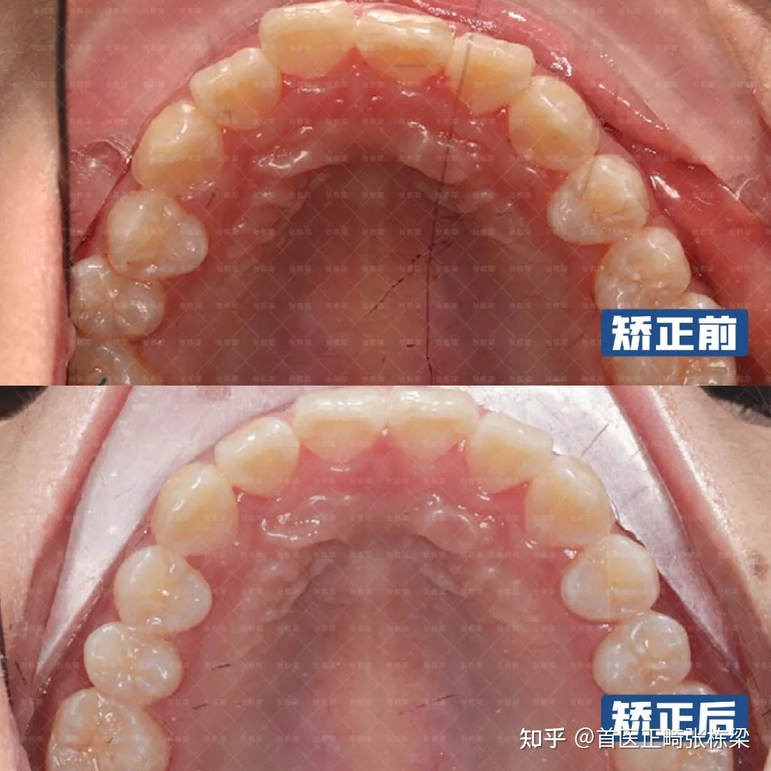青少年面中凹陷、地包天、偏颌,牙齿矫正还有机会改善吗? - 知乎