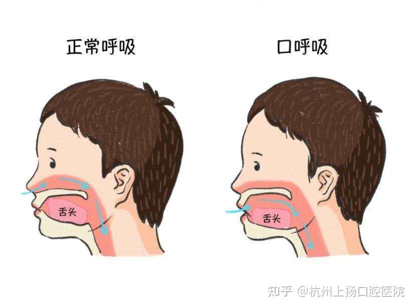 q1:张嘴呼吸会让人「变丑?