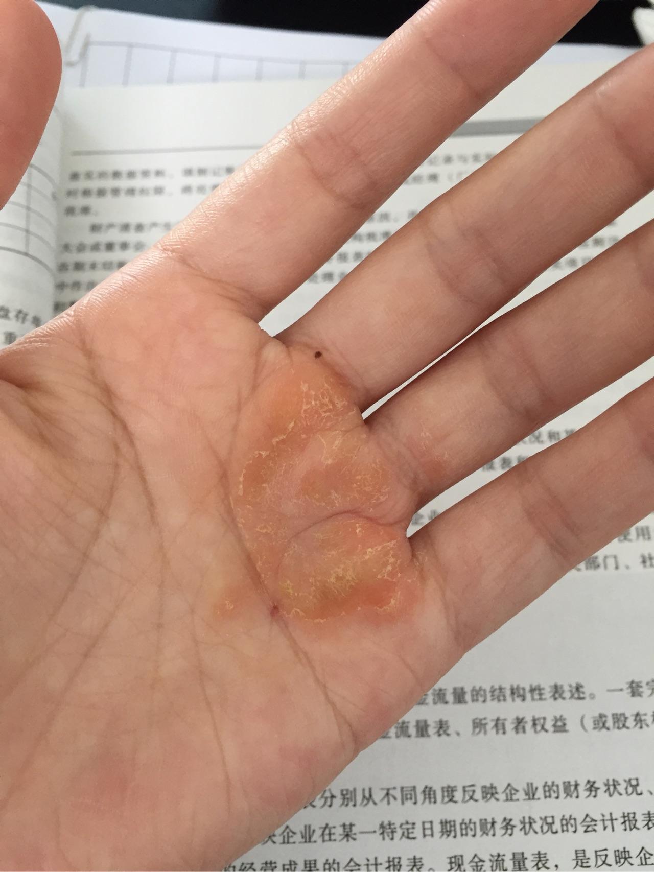 手指长水泡一直不好是湿疹还是手癣还是神马