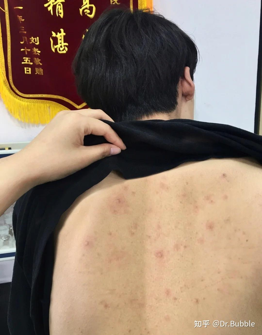 从医学的角度来说为什么后背长痘一定要抑制金黄色葡萄球菌