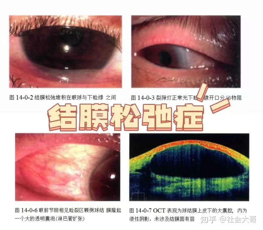 泪液动力学异常型干眼 - 知乎