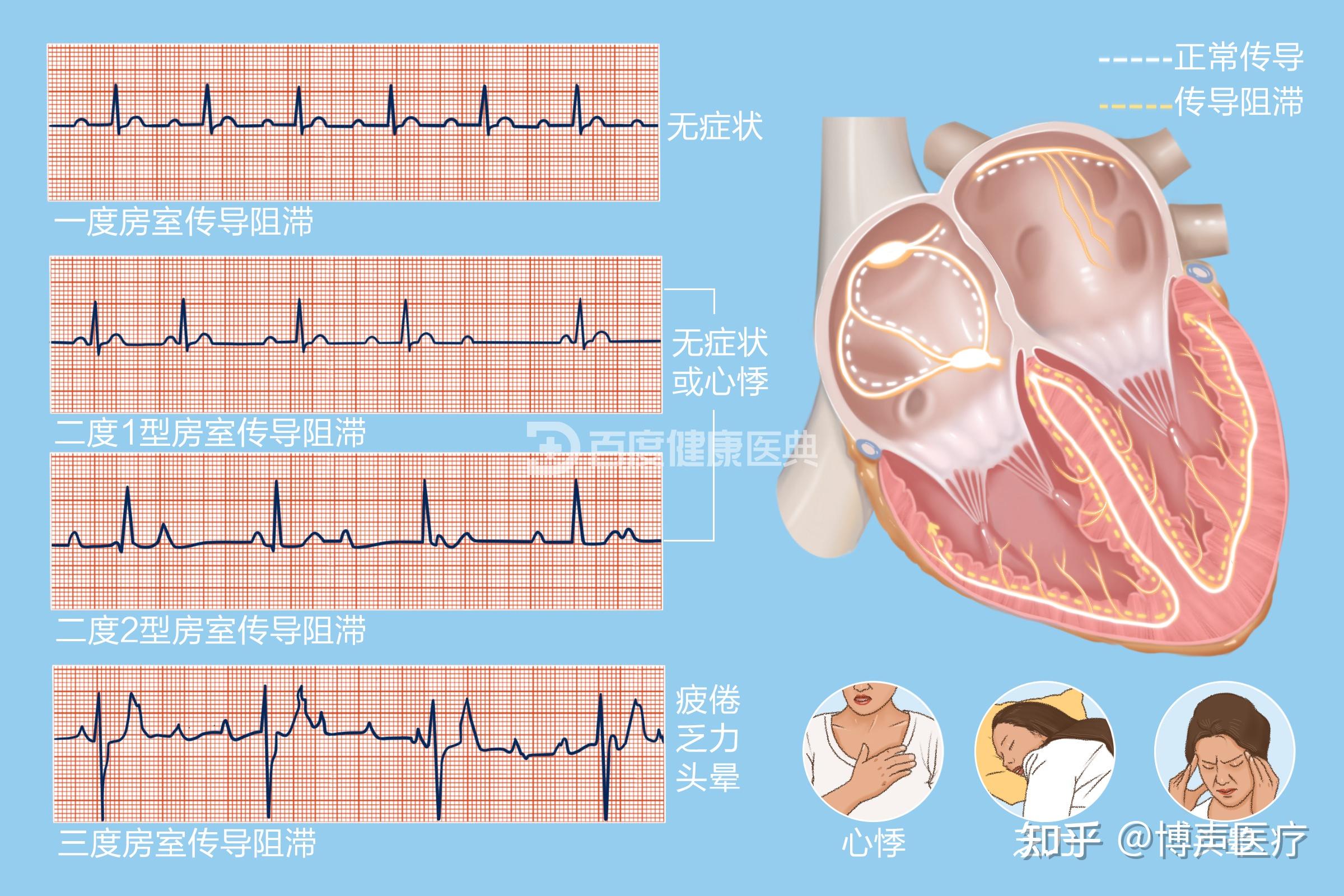 传导阻滞心电图特点图片