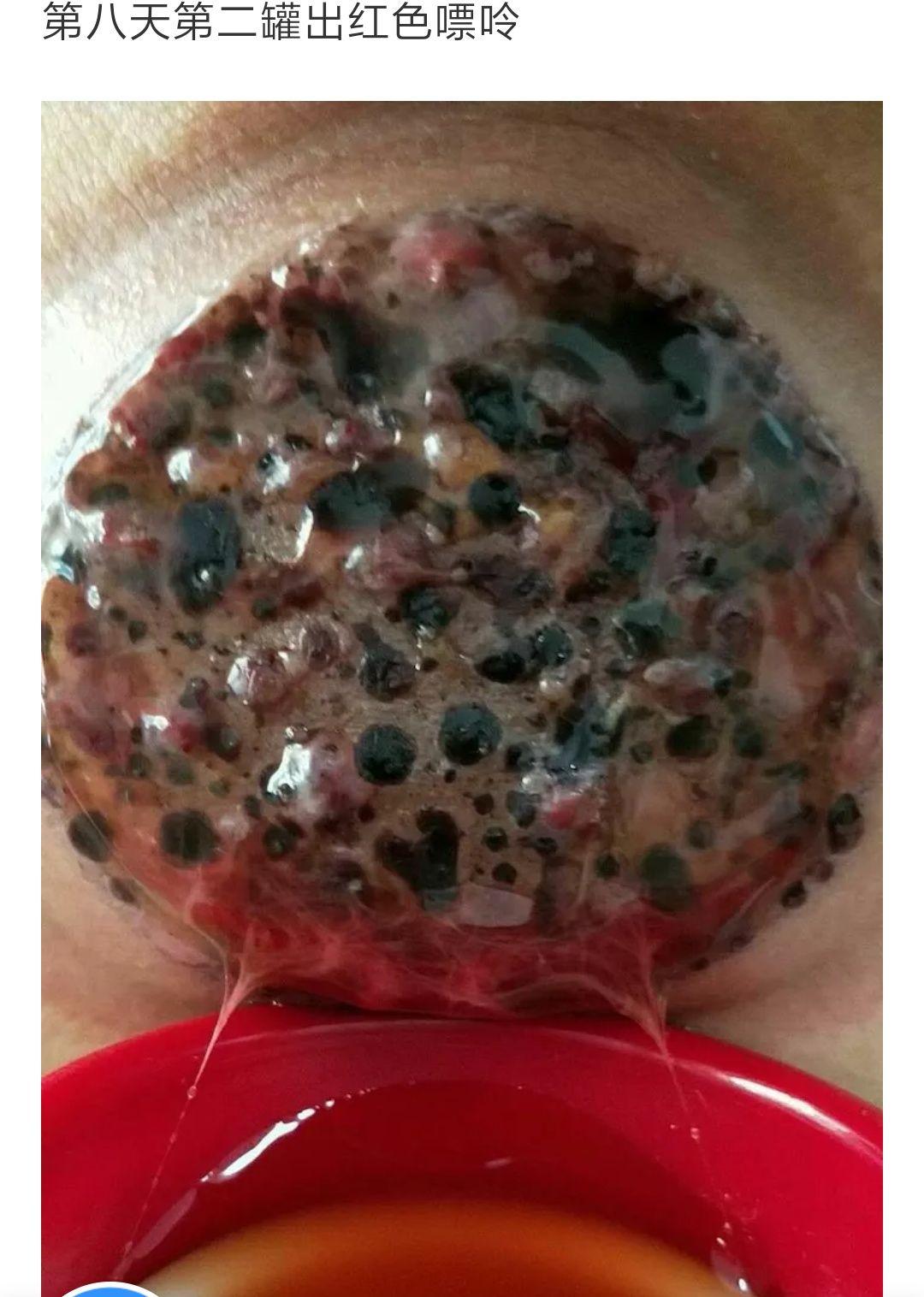 春草拔罐到底有用吗有没有副作用啊