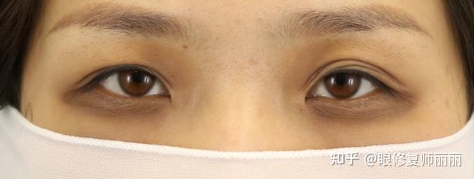 双眼皮多层褶/多层眼皮可以进行修复吗?效果怎么样? - 知乎