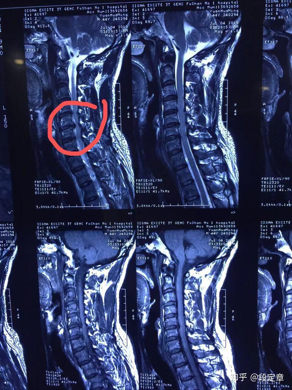 椎间盘突出与腰肌劳损