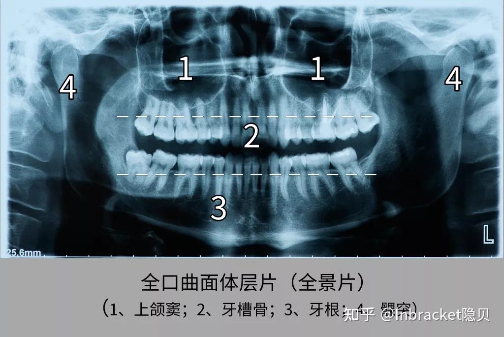 如何看牙齿x光片图片