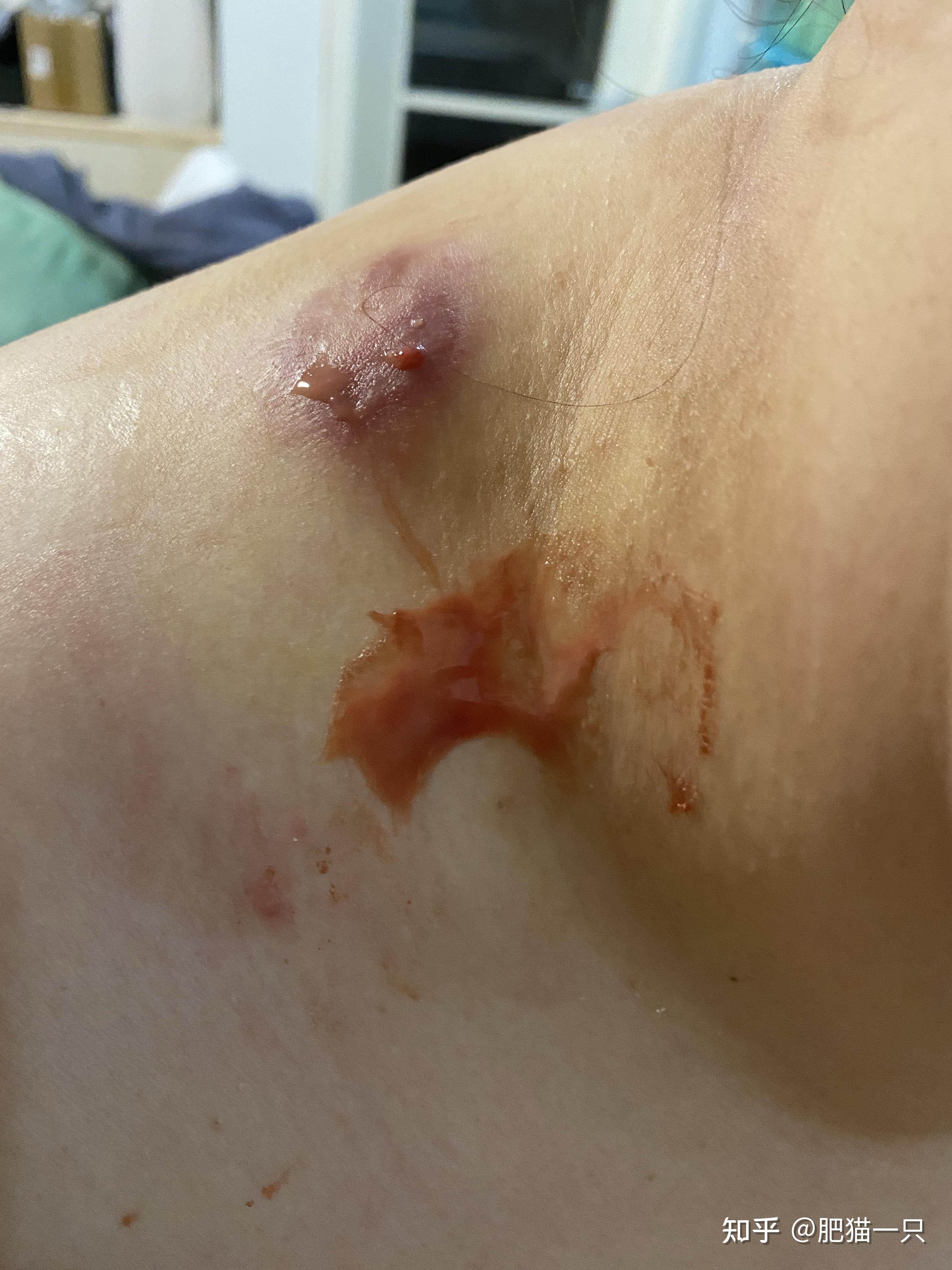 粉瘤到底是什么