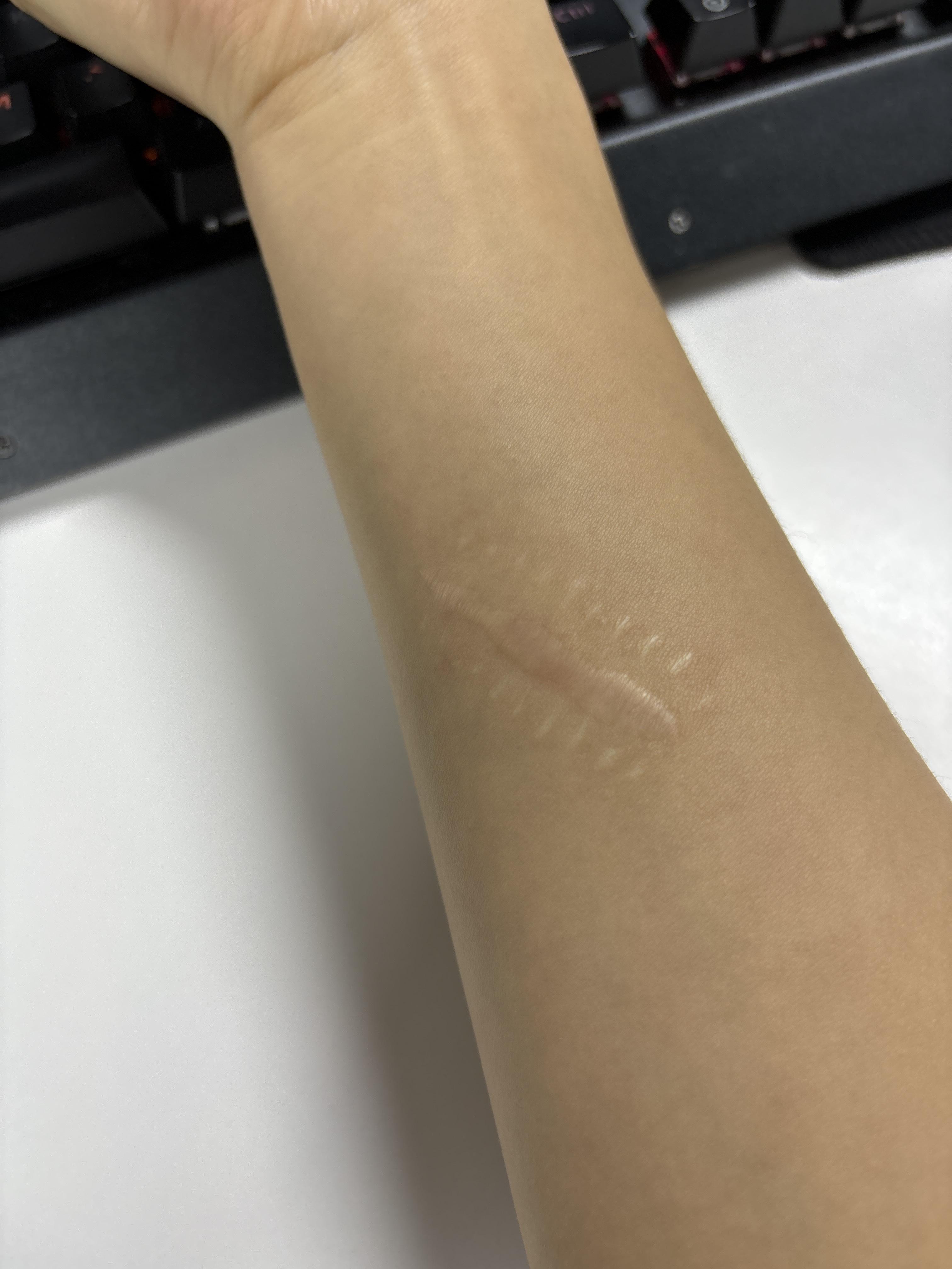 用什么方法才能修复伤疤? - 知乎