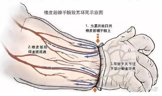 皮筋,頭髮等環狀物纏繞在寶寶手腳上,相當於一個止血帶,會影響血液