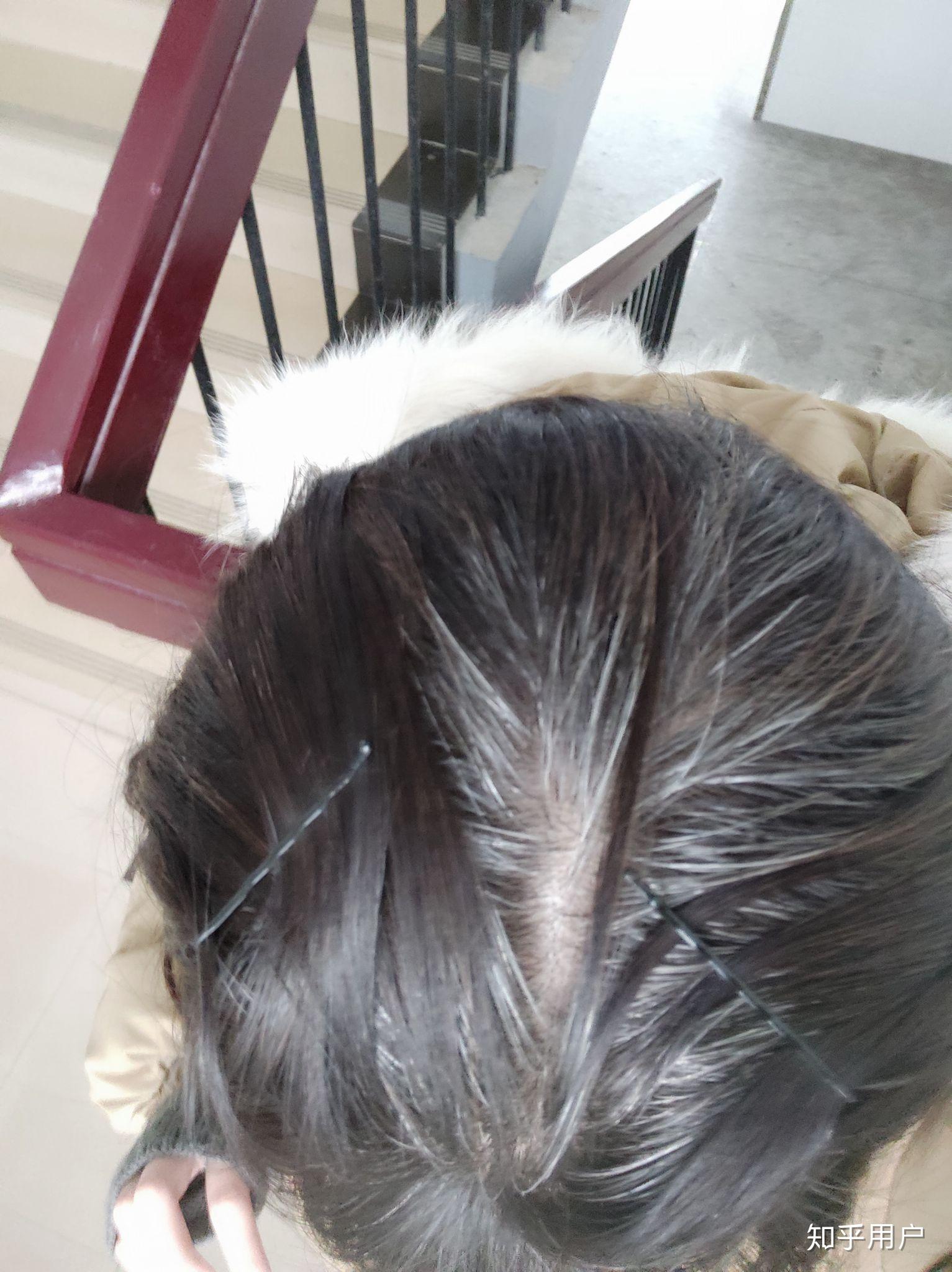 有少白头是怎样一种经历