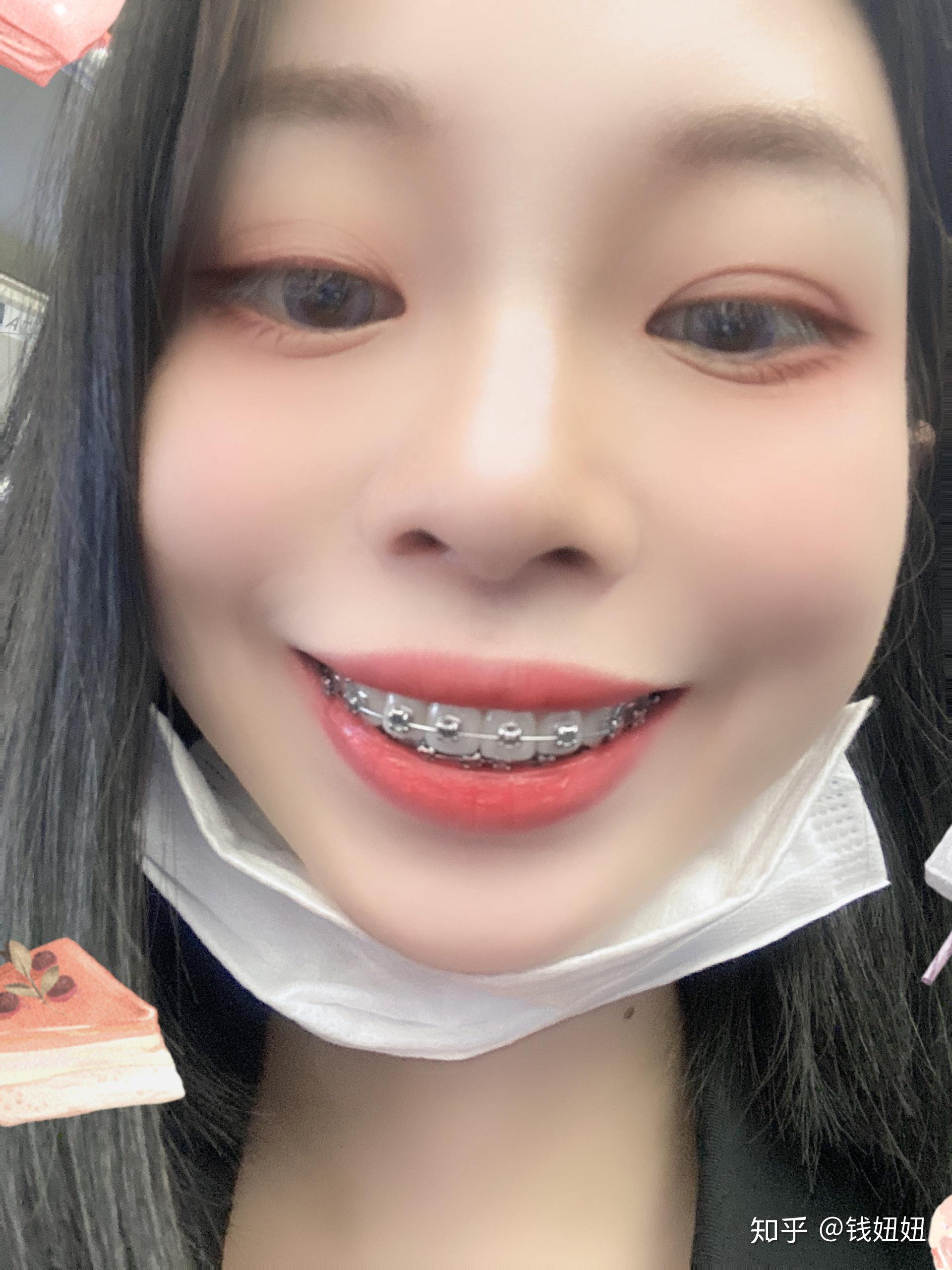 带牙套会影响男生对女生的感觉嘛 ? - 知乎