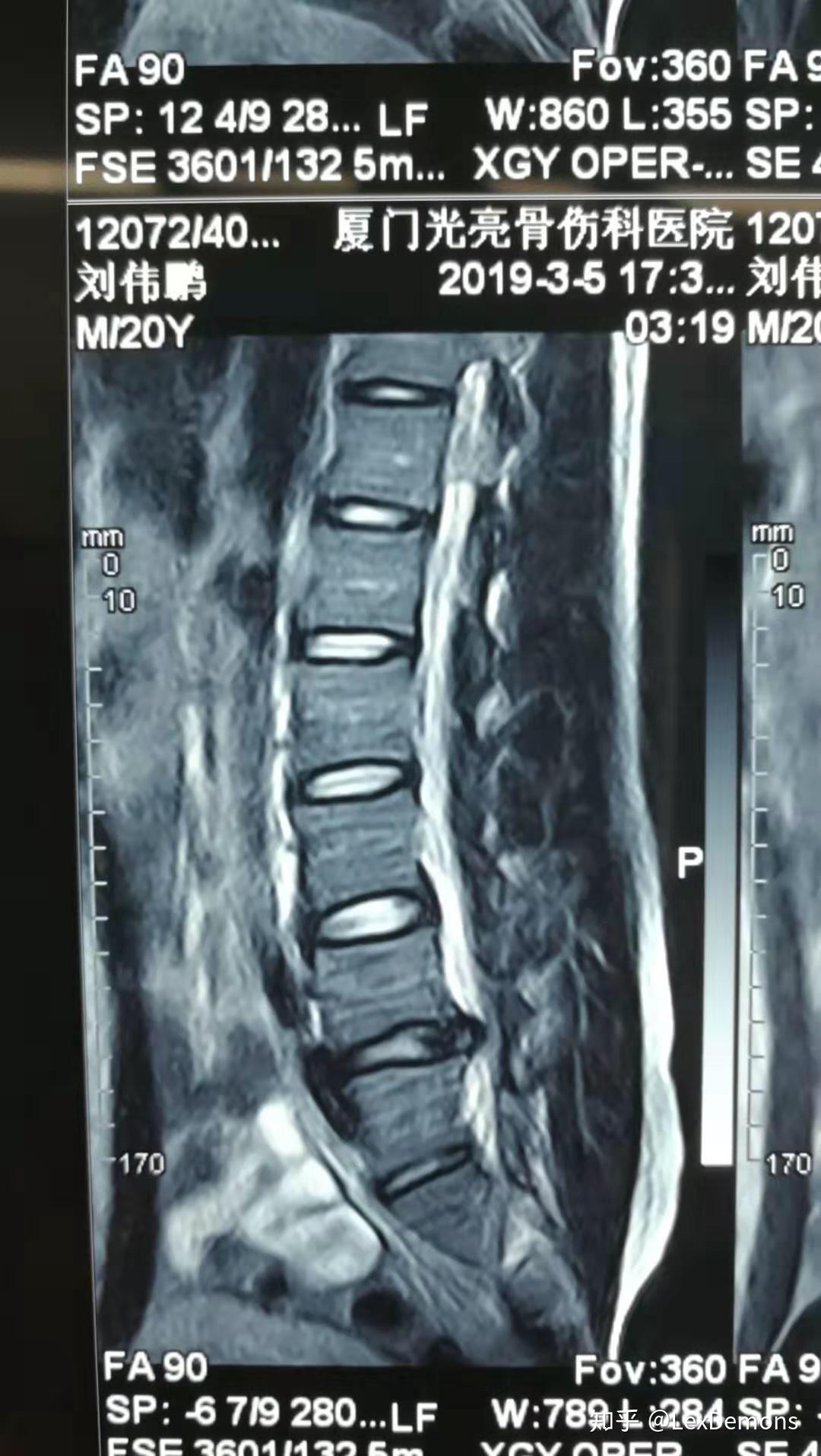 腰间盘突出微创手术是什么原理_腰间盘突出微创手术图