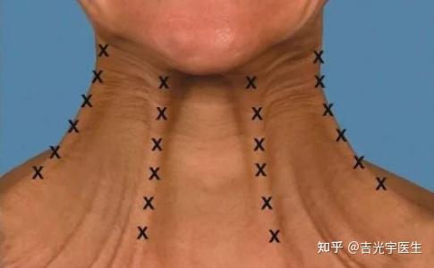 大家可以看下下面的图片,脖子上有一道道纵向的青筋暴起,这种问题被