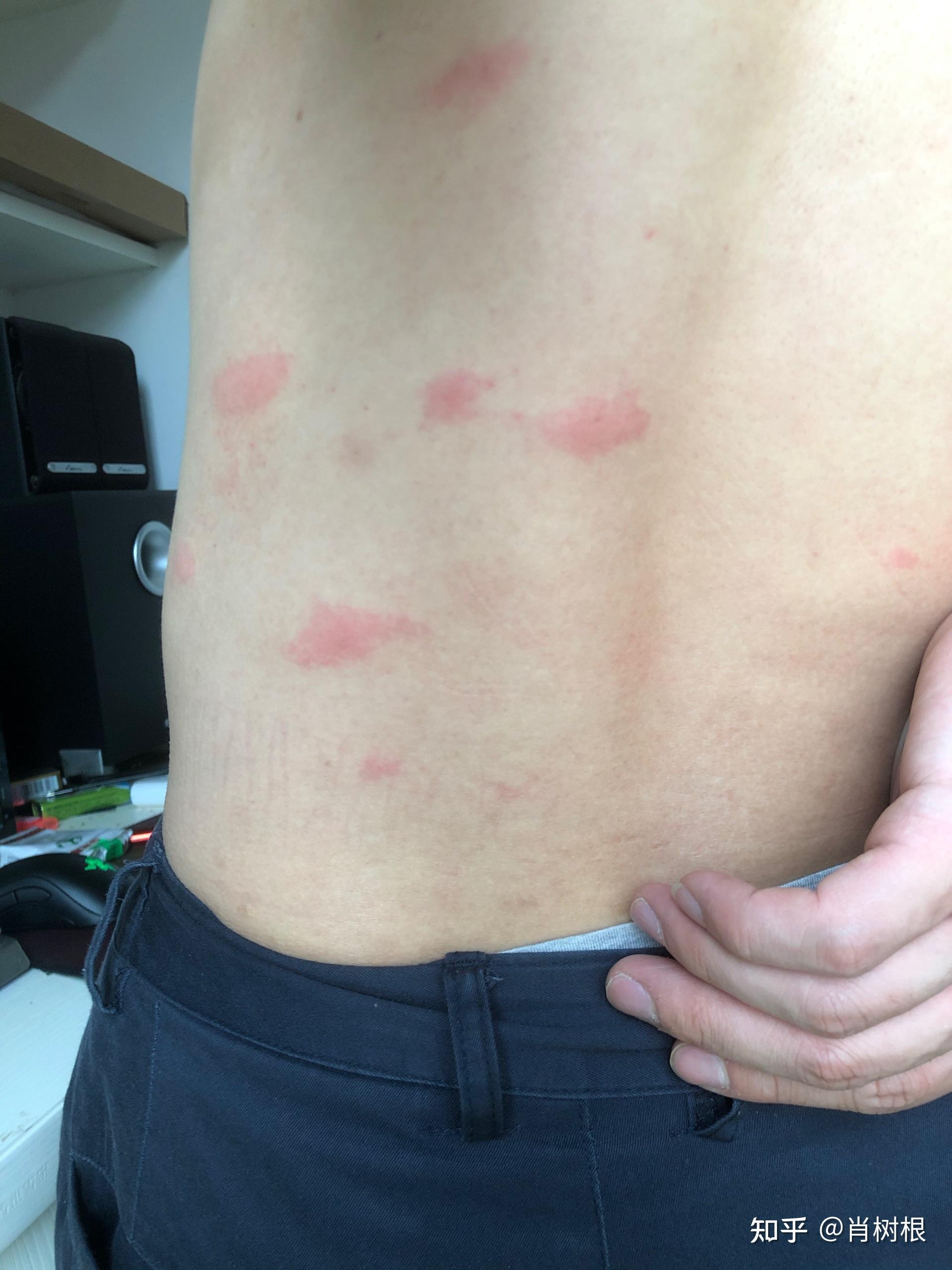 求助这是什么虫子咬的包