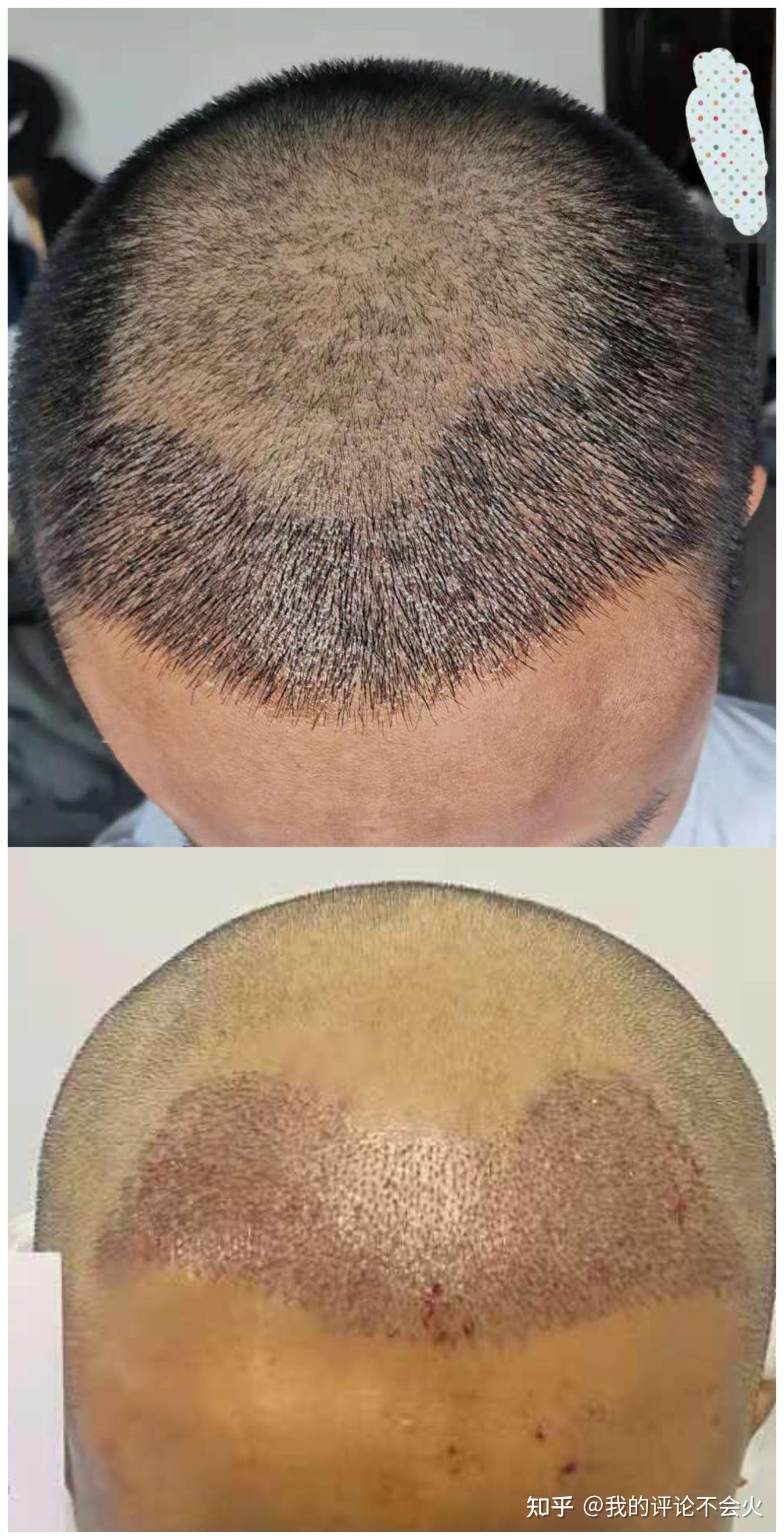 25岁秃头少年的自我救赎——植发及恢复实录（四）——植发半年回顾 - 知乎
