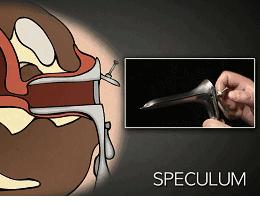 妇科检查的"鸭嘴钳",真的是"当代女性刑具"吗?