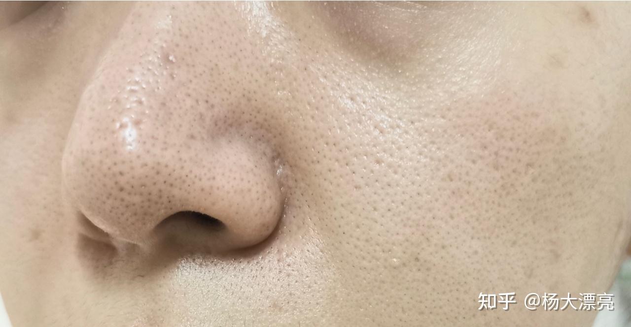 怎样有效去黑头收缩毛孔? - 知乎