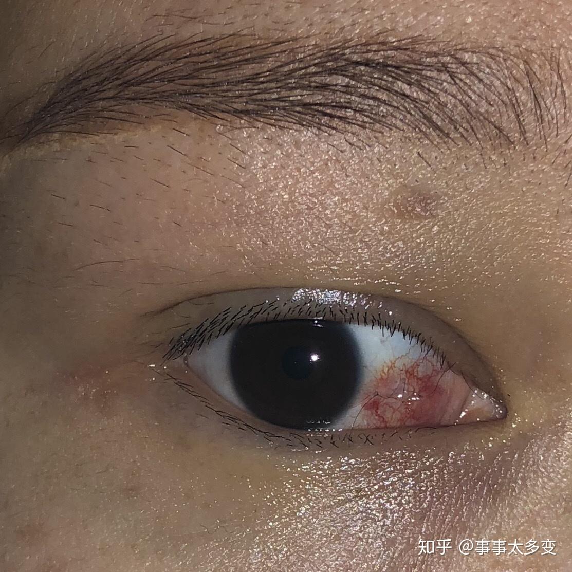 眼结膜色素痣治疗记录