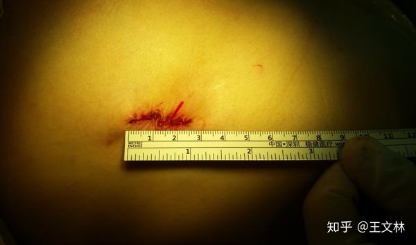 重度桶状胸的小手术