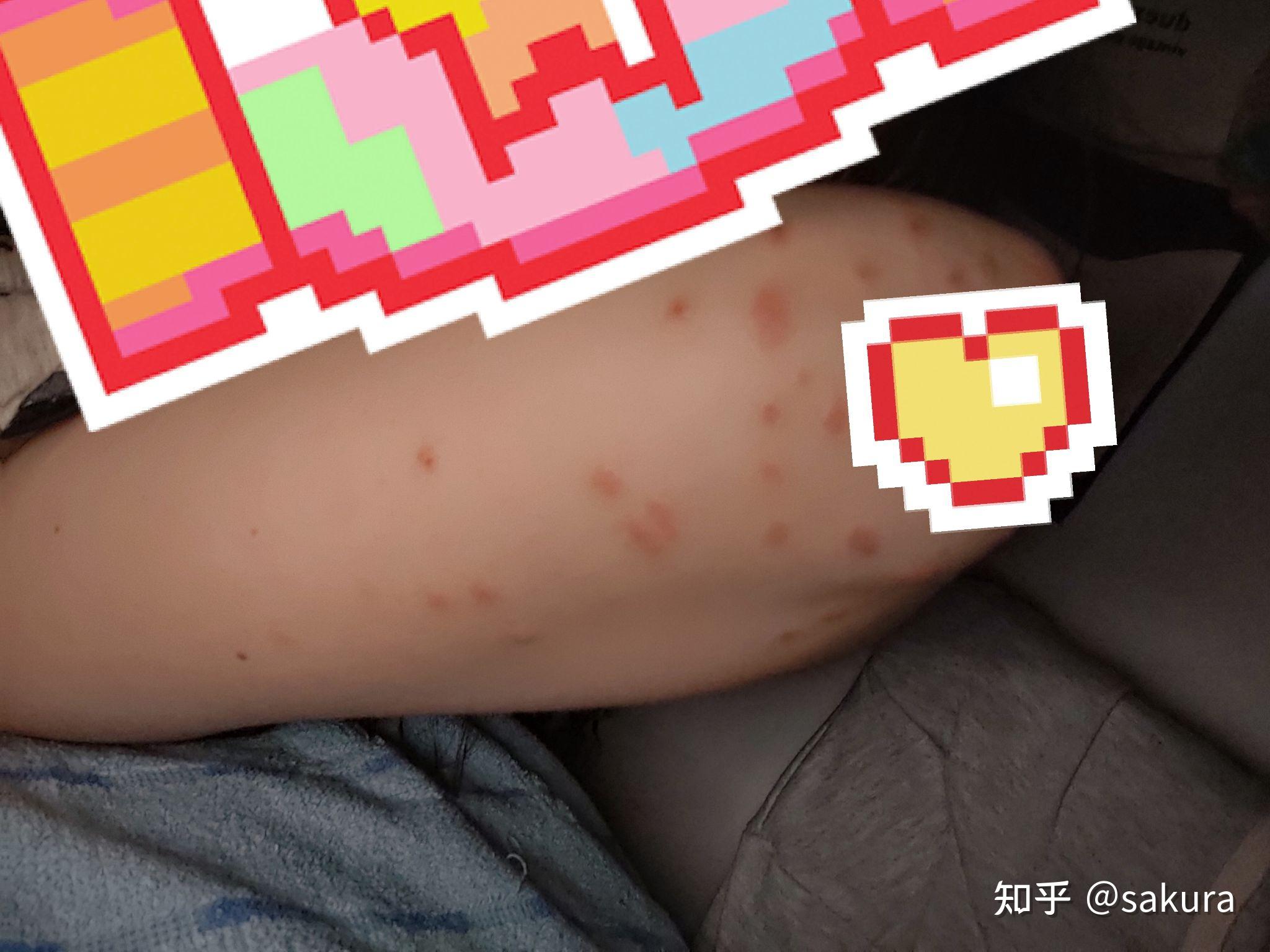 丘疹性荨麻疹? - 知乎