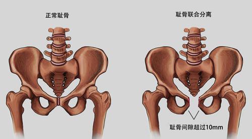 耻骨是哪个位置 真人图片