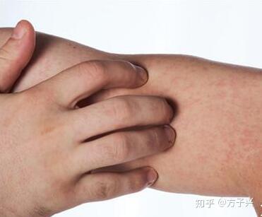 糖尿病引起静脉曲张的并发症与症状有哪些 糖尿病并发症静脉曲张 爱号网