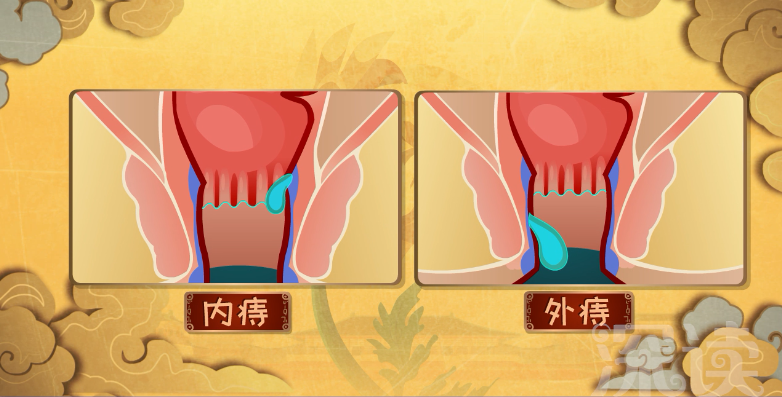痔疮到底是什么样的症状如何区分内外痔