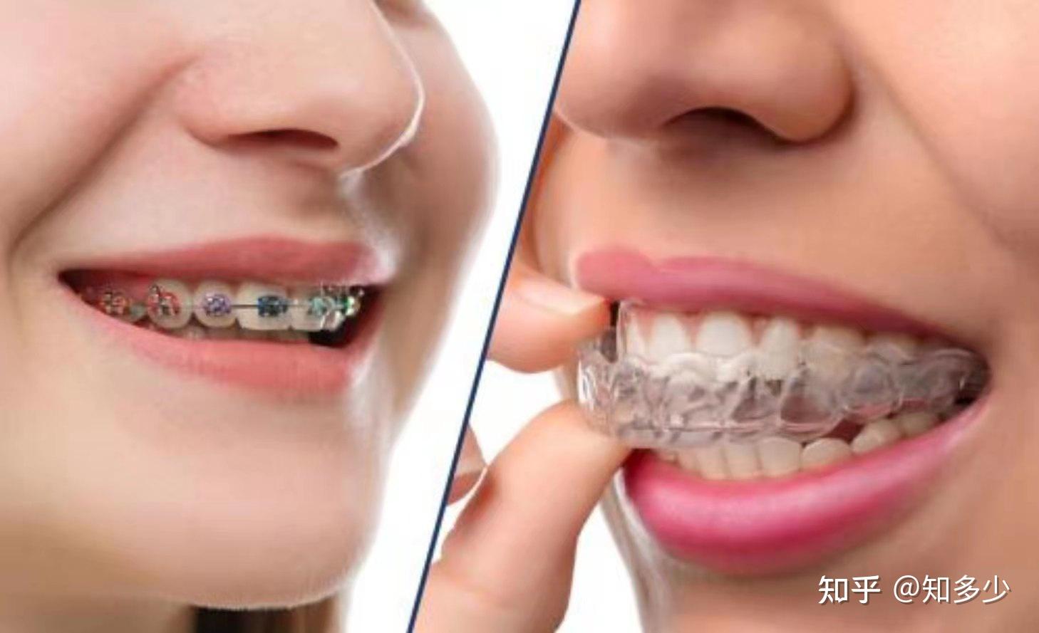 苏州牙齿矫正-进口托槽自锁牙套矫正案例分享 - 知乎