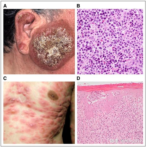 成人t细胞白血病 Adult T Cell Leukemia Atl 知乎