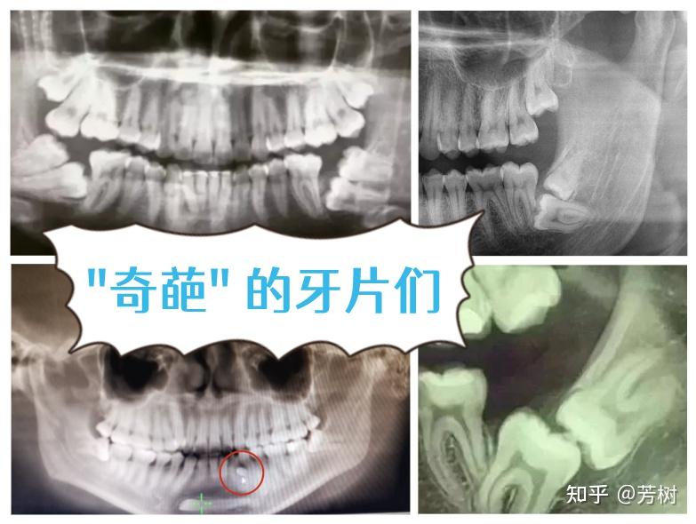 成都聖貝提醒你看牙拍片很重要內含實測照片