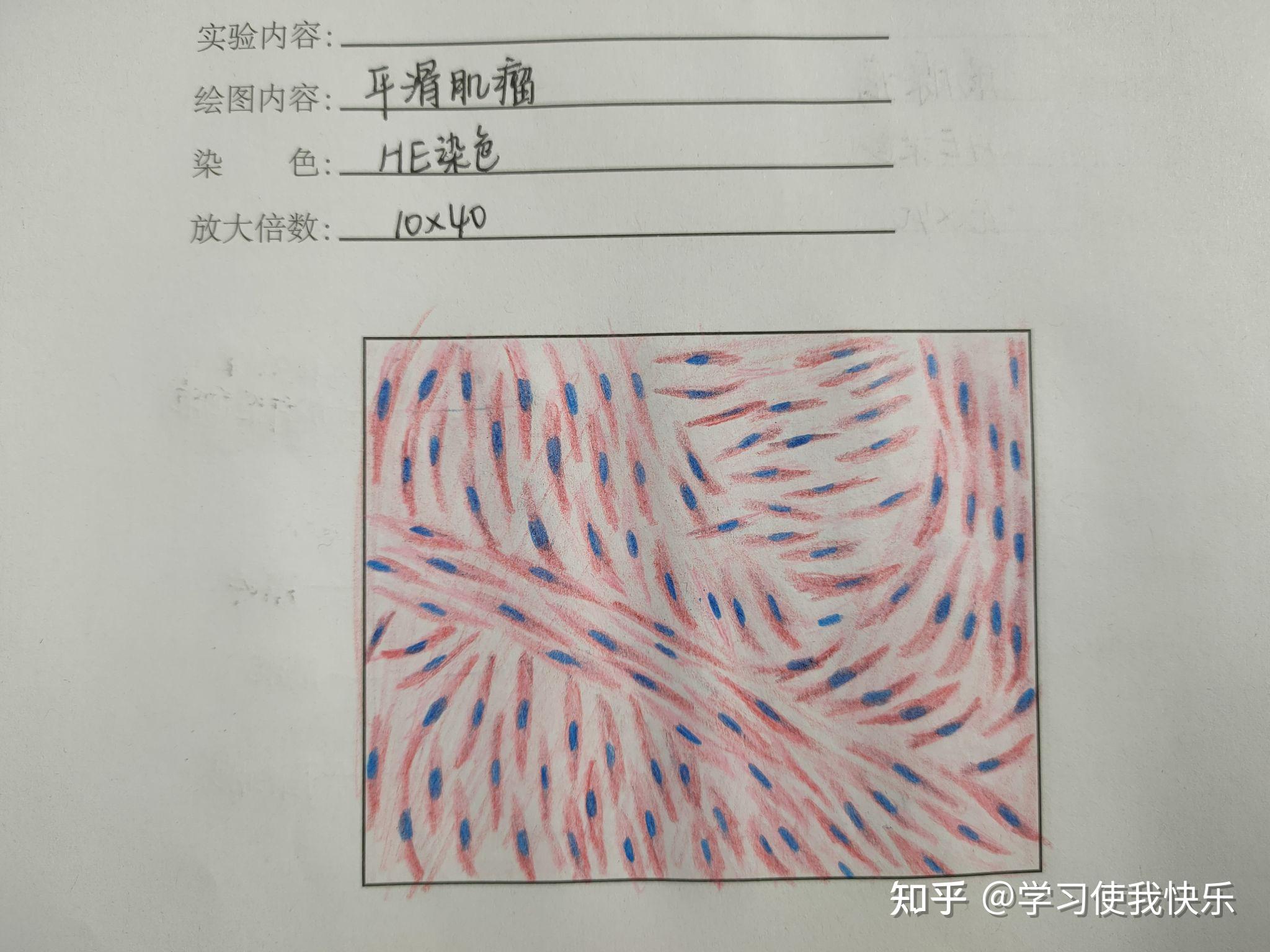 平滑肌肉瘤红蓝铅笔图图片