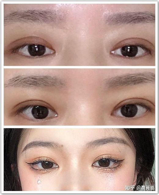 成都卢尚兵医生修复双眼皮做的怎样