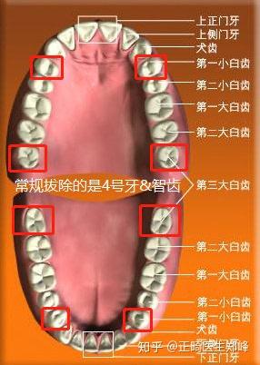 为什么矫正拔牙一般拔4号5号牙